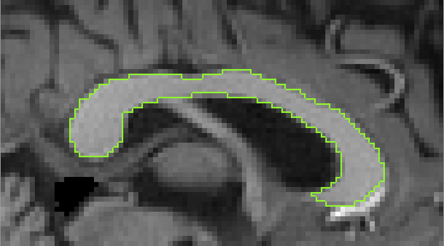 Corpus Callosum Classification